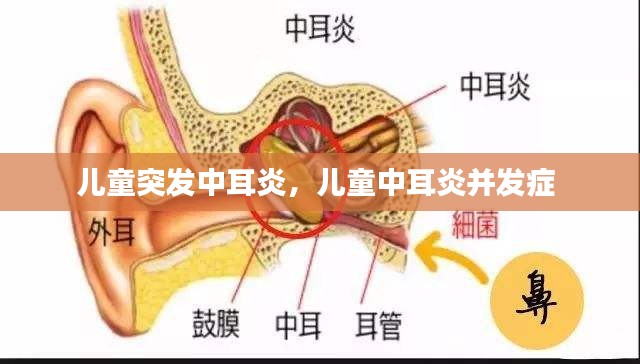 兒童突發(fā)中耳炎，兒童中耳炎并發(fā)癥 